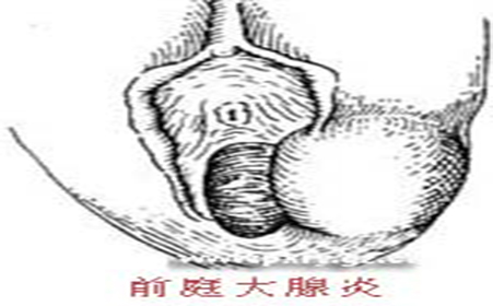 苏州妇科医院哪好_前庭大腺囊肿反复发作什么原因