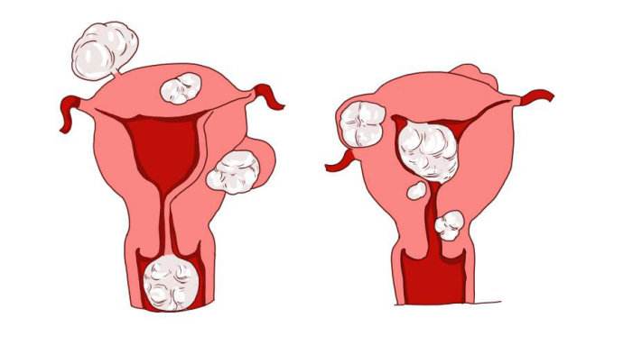 苏州哪个医院看妇科好,子宫肌瘤影响性生活吗