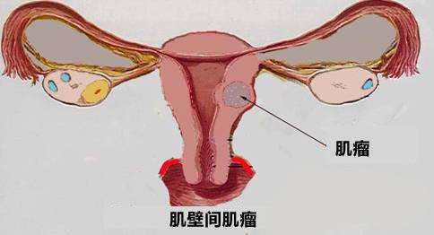 苏州专业妇科子宫肌瘤医院_子宫肌瘤怎么形成的