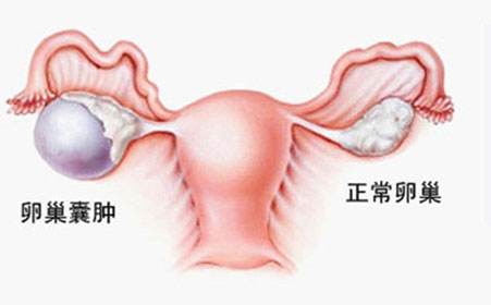 苏州市妇科医院_卵巢囊肿的病因及预防