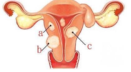 苏州子宫肌瘤妇科医院_子宫肌瘤的病因与症状