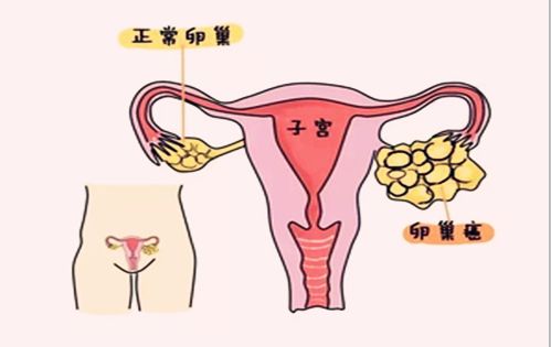 苏州姑苏区好的妇科医院_卵巢癌怎么来的