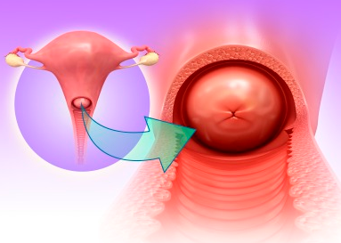 苏州女性宫颈肥大怎么办？